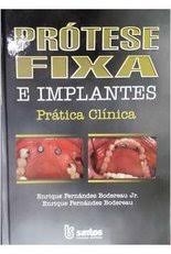 Prótese fixa e implantes : prática clínica